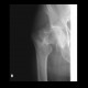 Basicervical fracture of femur: X-ray - Plain radiograph